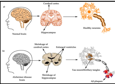 Alzheimer's