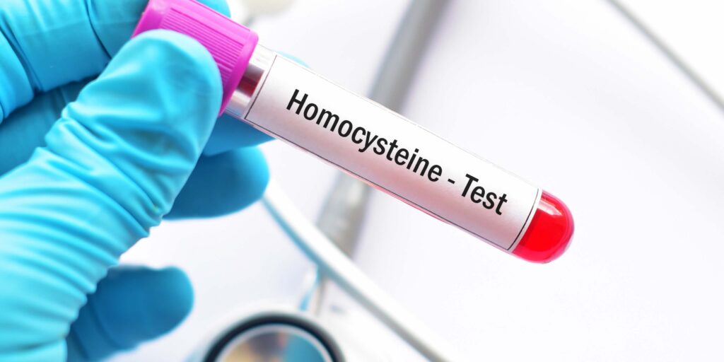 Homocysteine Testing: Complete Guide on at home kit, blood test